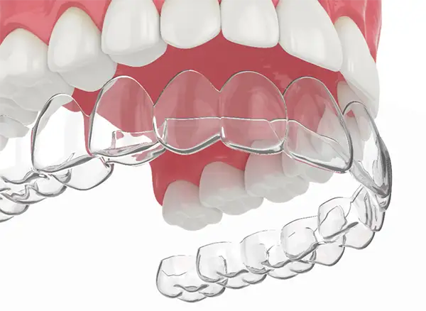 SureSmile Clear Aligners