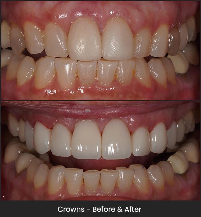 Crowns and veneers